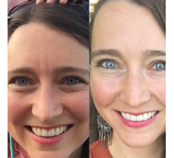 Antes y después de usar los parches contra las arrugas de Frownies