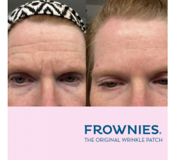 Antes y después de usar Frownies